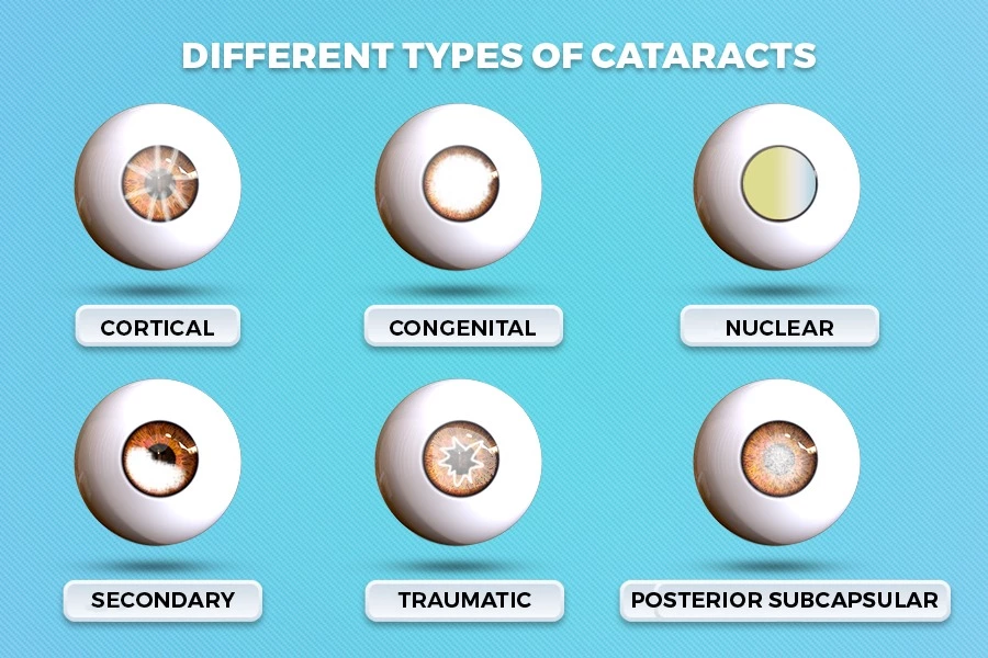 Cataract Operation in Mumbai