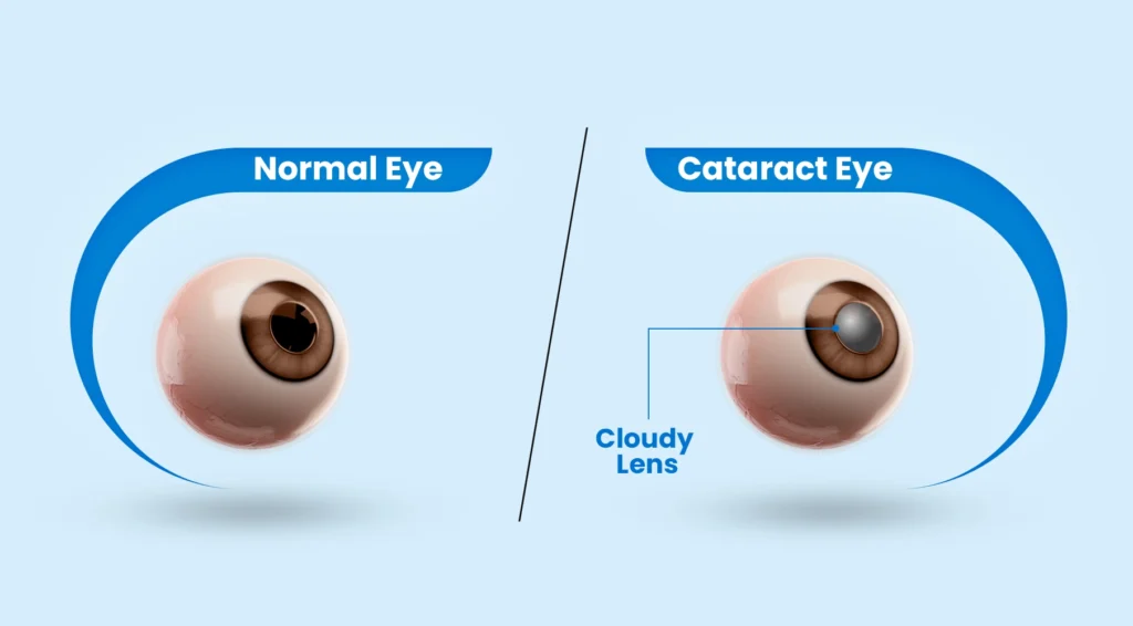 Cataract Treatment in Mumbai