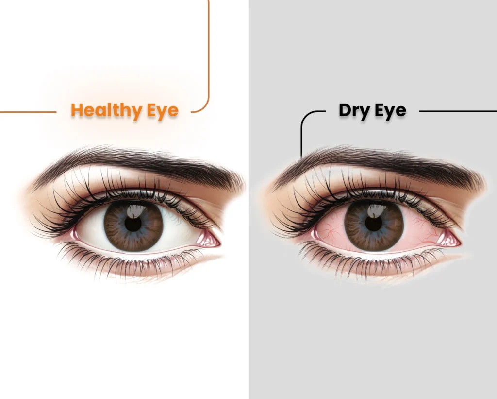 Best Dry Eye Treatment