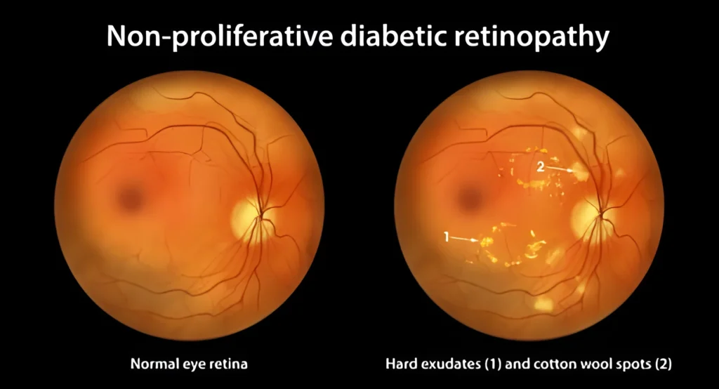 Best Treatment for Diabetic Retinopathy