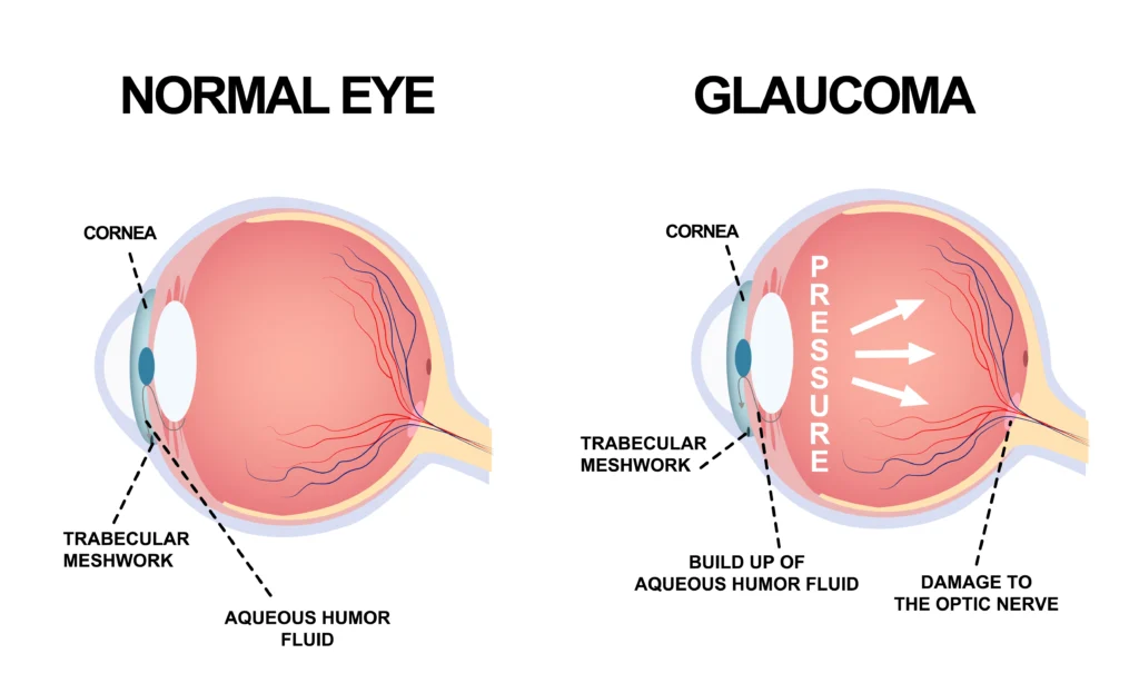 Understanding Glaucoma