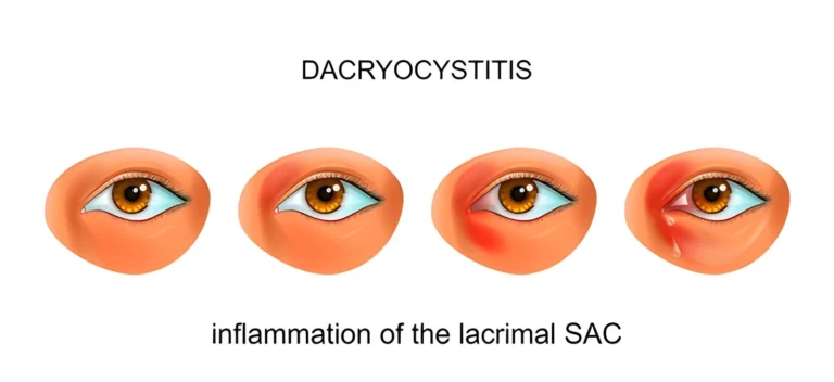 dacryocystitis treatment